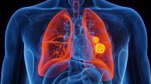 Un nuevo paradigma en el cáncer de pulmón: los tratamientos hoy permiten curar la enfermedad o volverla crónica en cada vez más casos